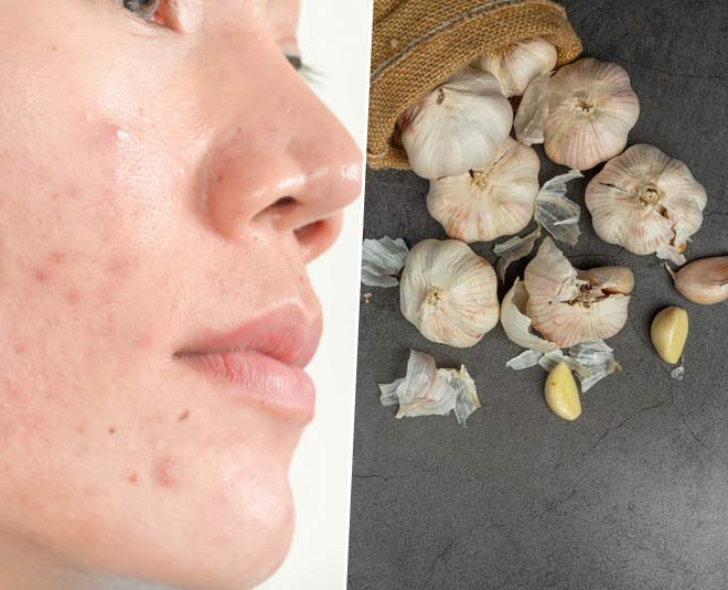 garlic and acne
